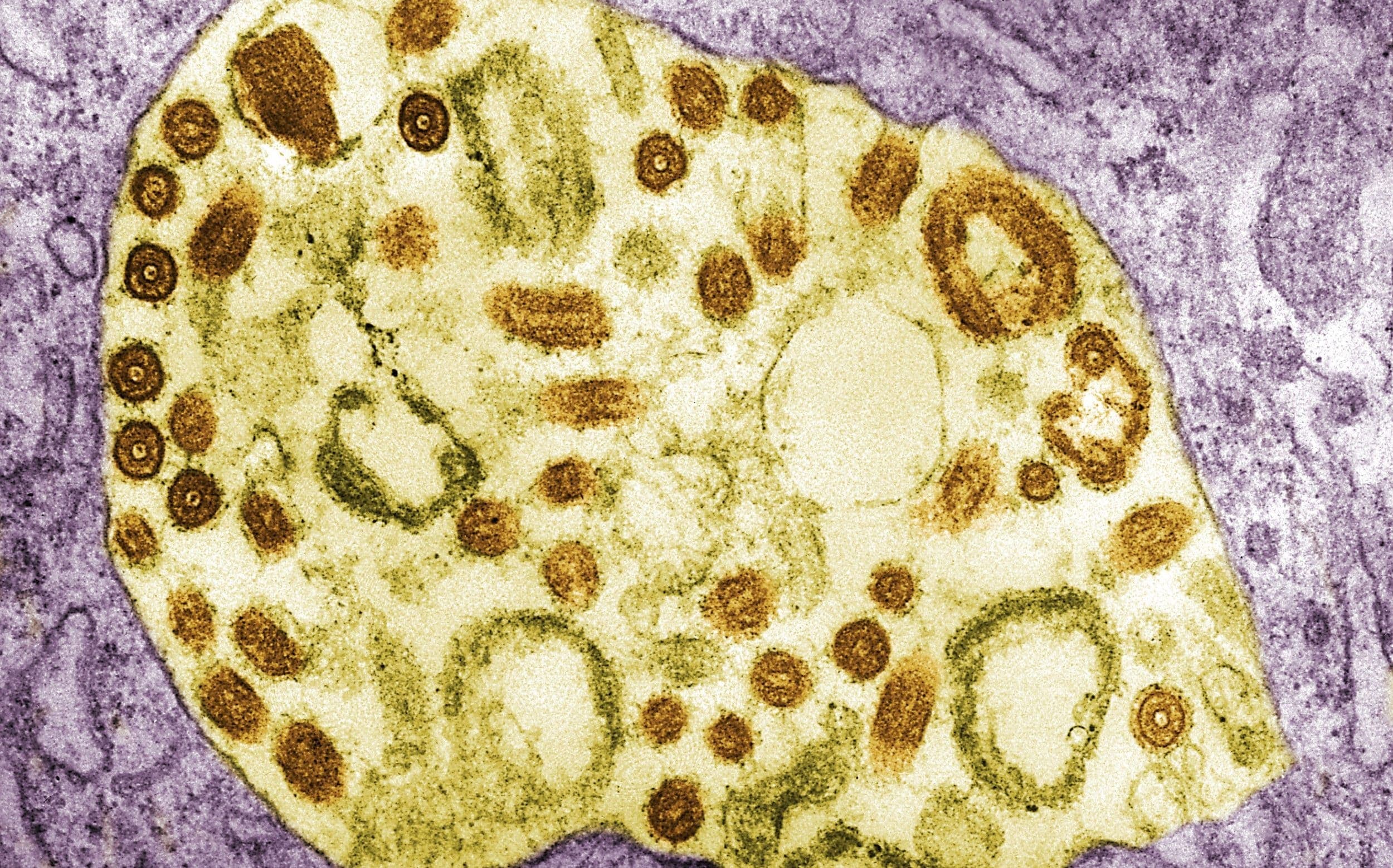 Marburg outbreak worsens in Ethiopia as death toll rises